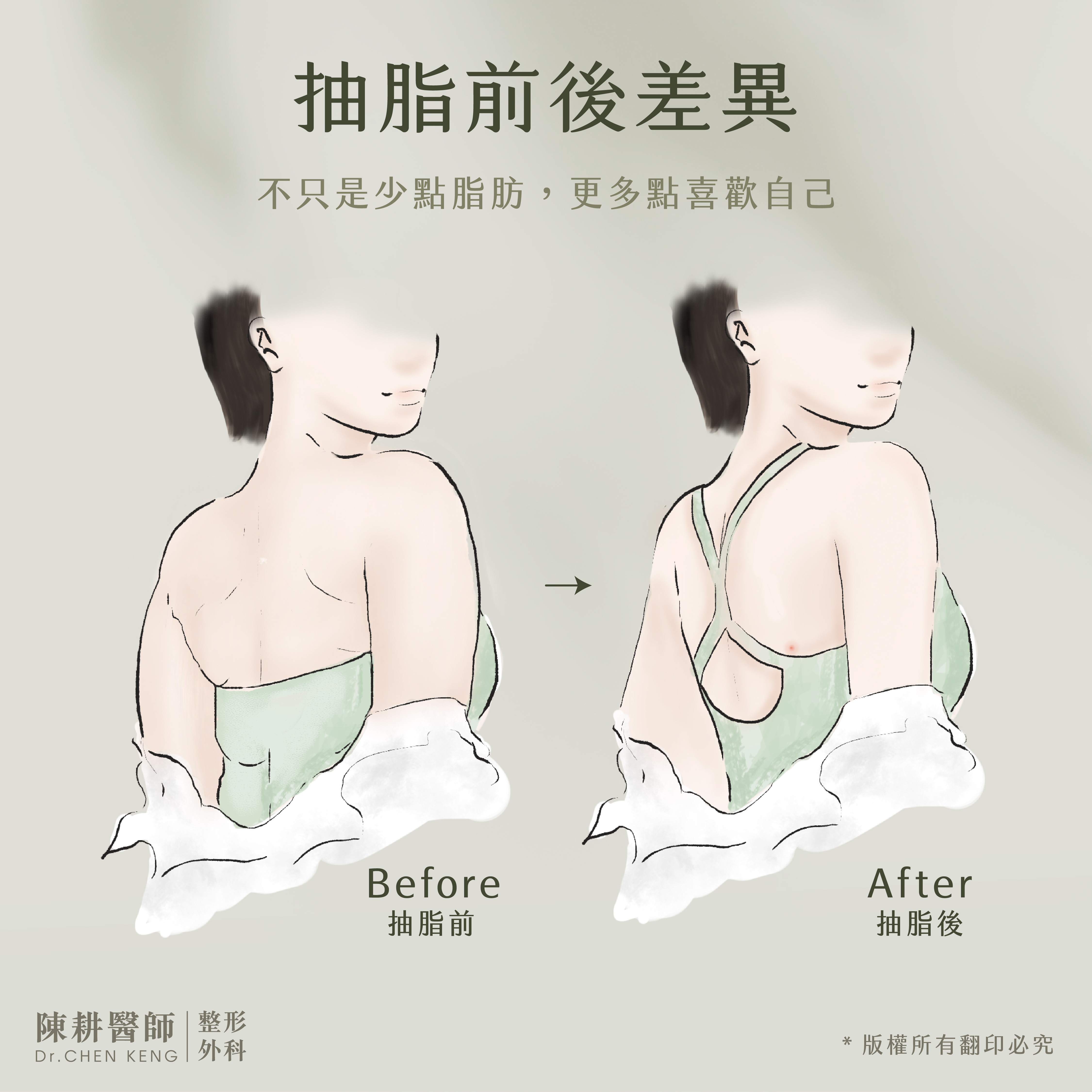 手臂抽脂，重塑身體精緻之美