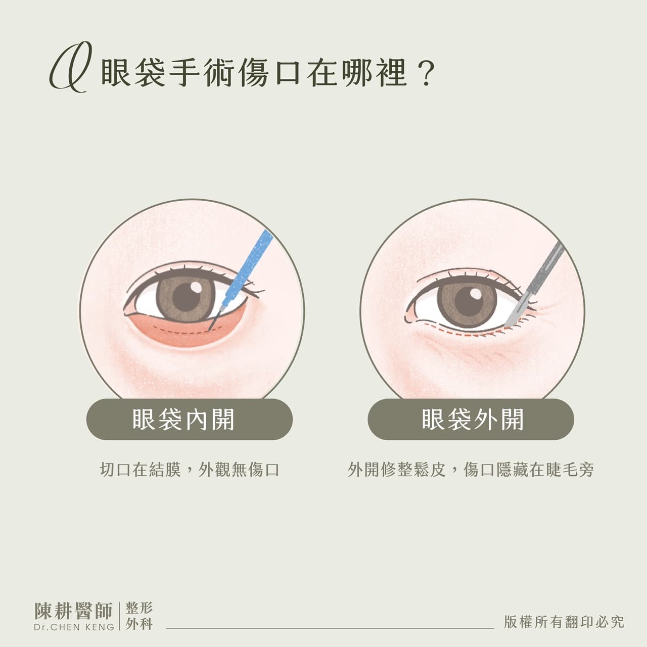 眼袋內開外開差別