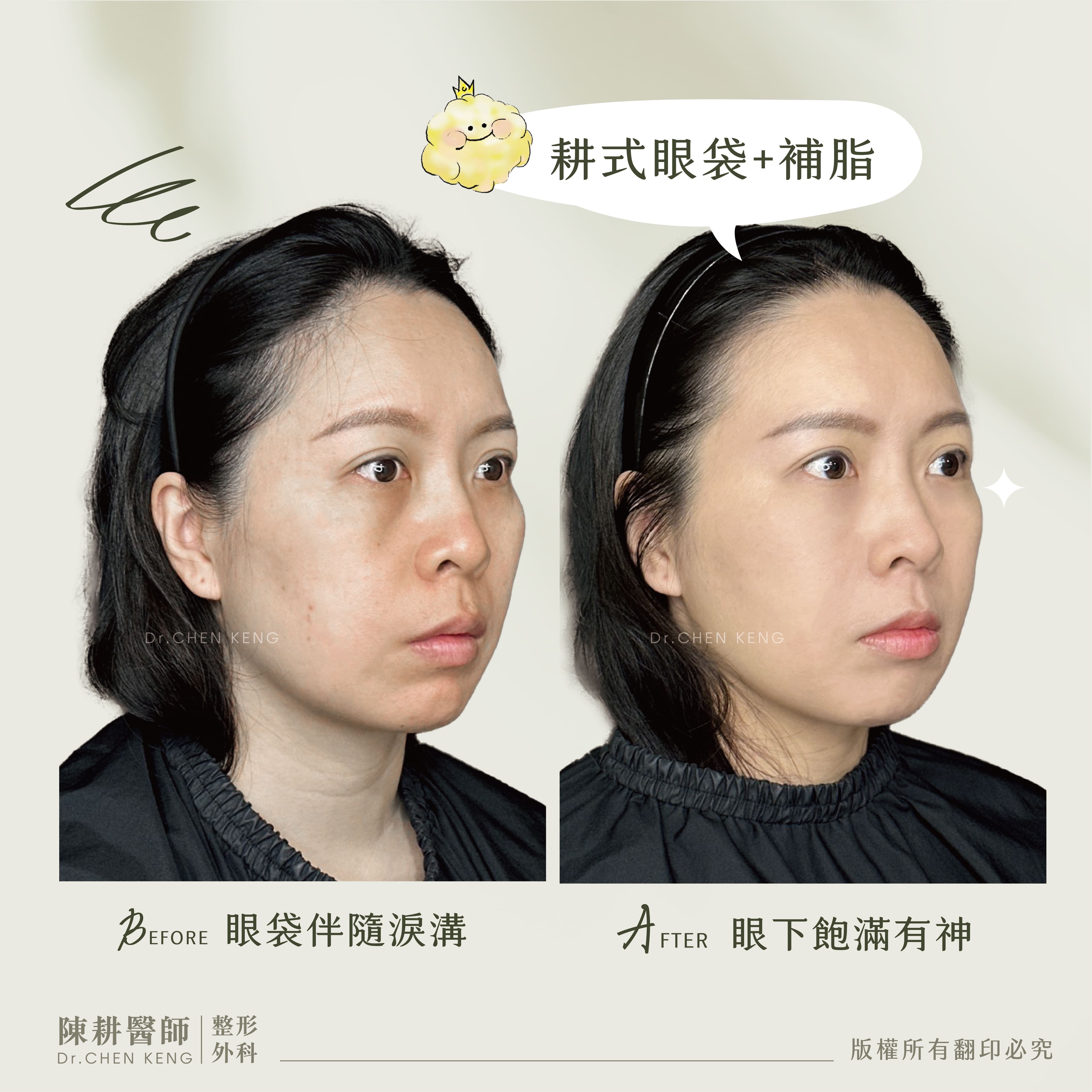 眼袋內開補脂-1