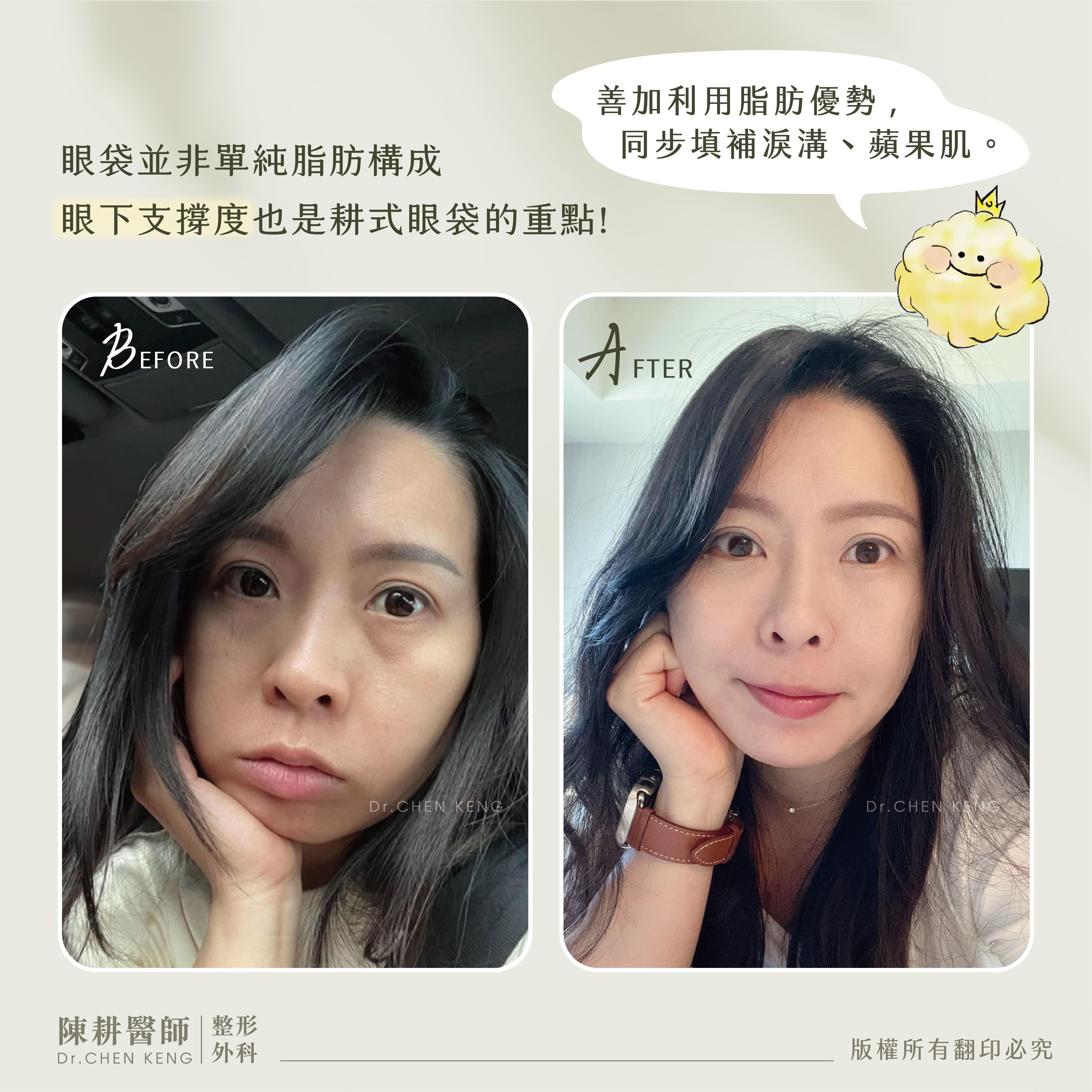 眼袋補脂手術保養