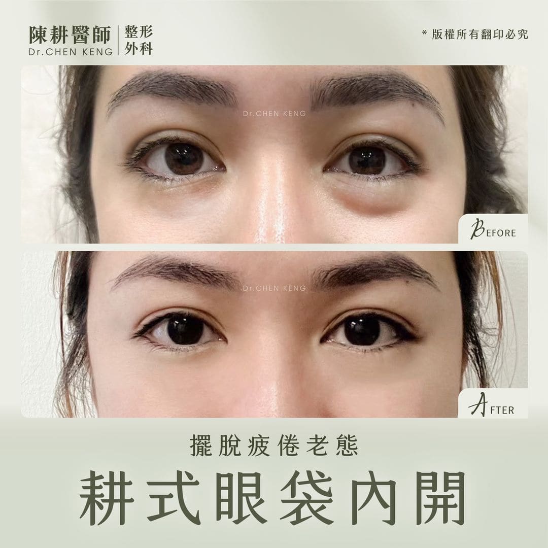 眼袋手術臥蠶會不見嗎?