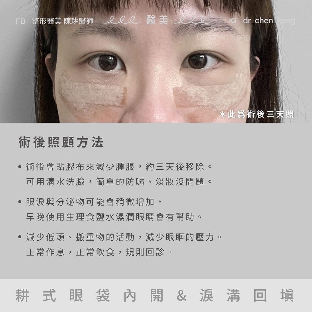 內開眼袋術後照顧