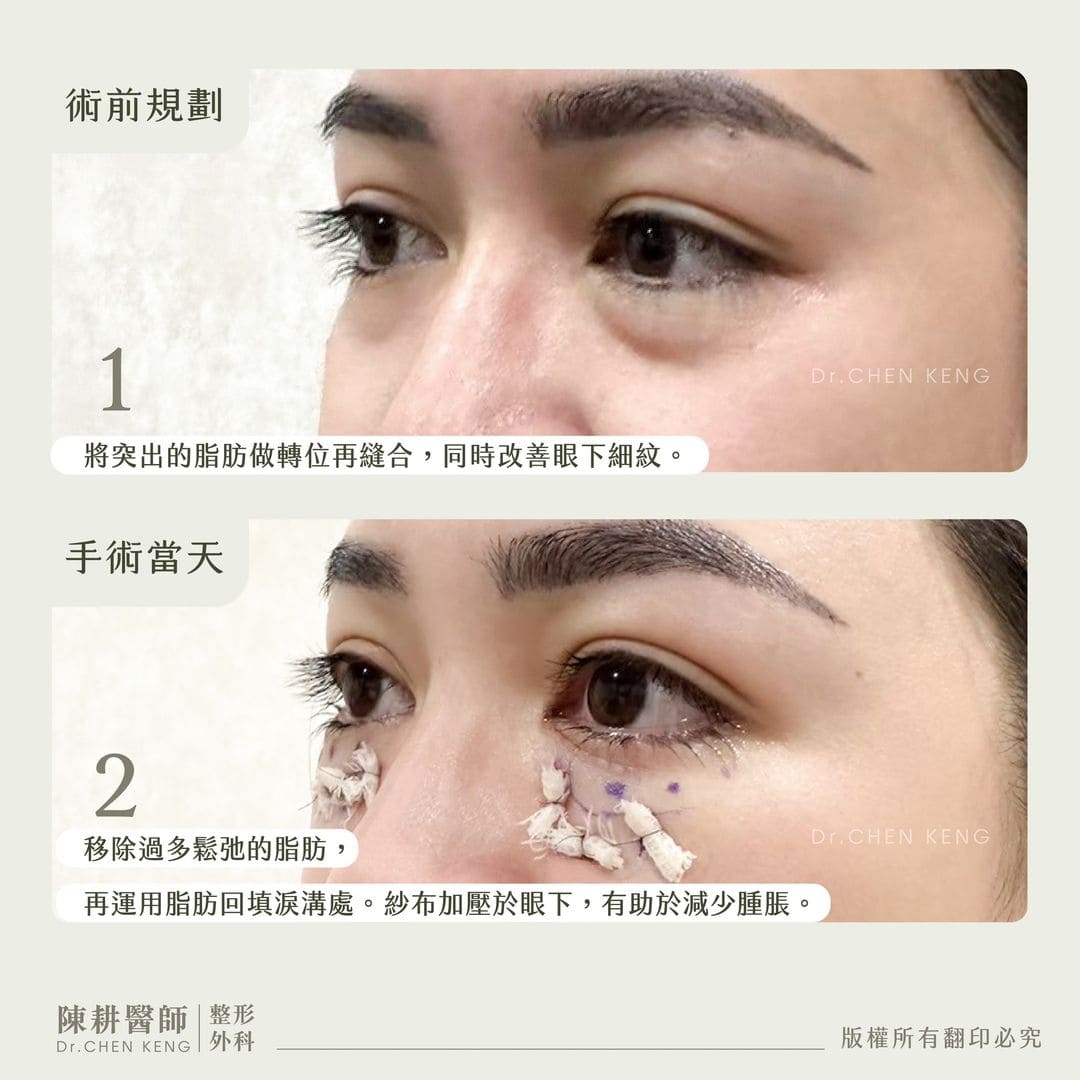 眼袋手術術後保養