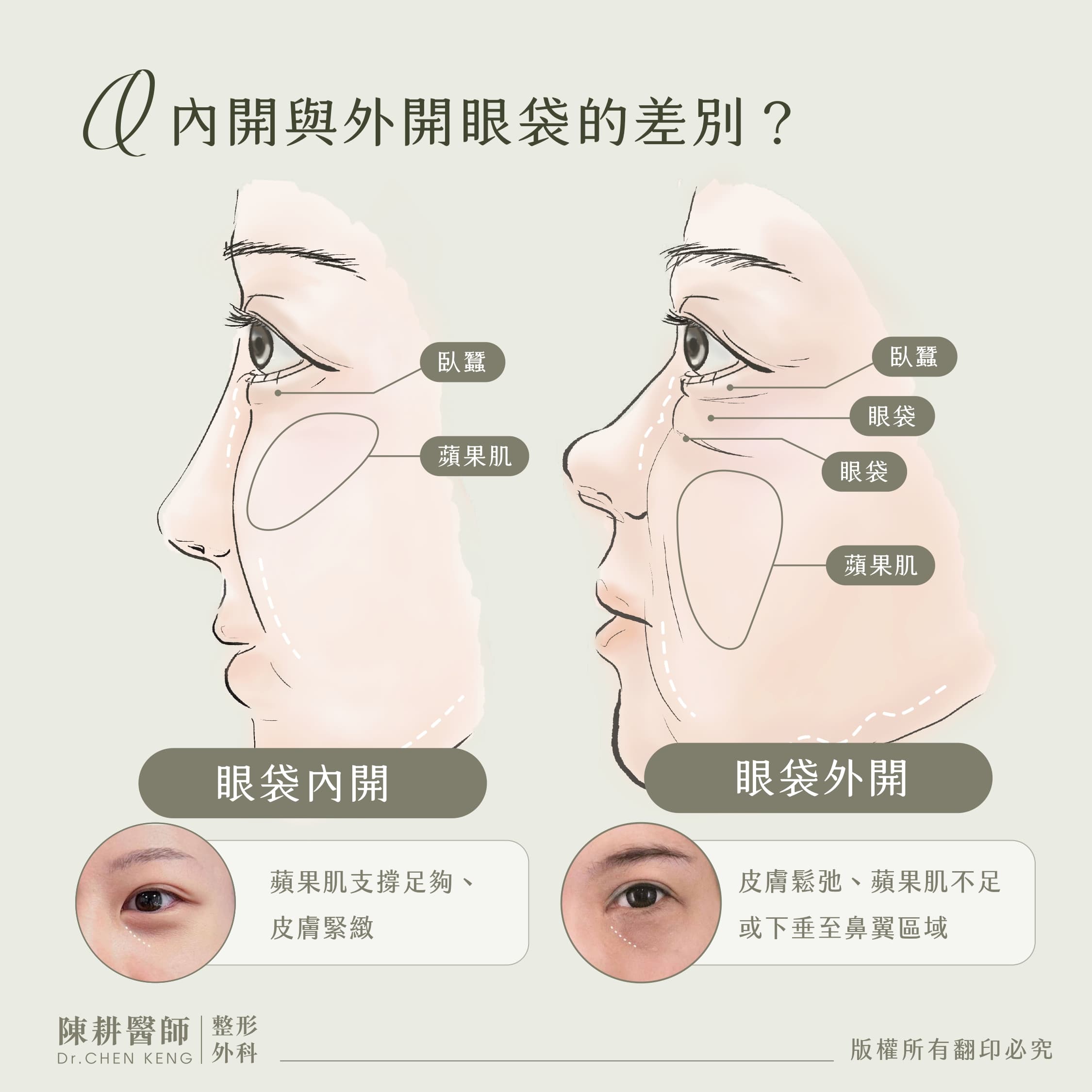 眼袋內開與眼袋外開差別