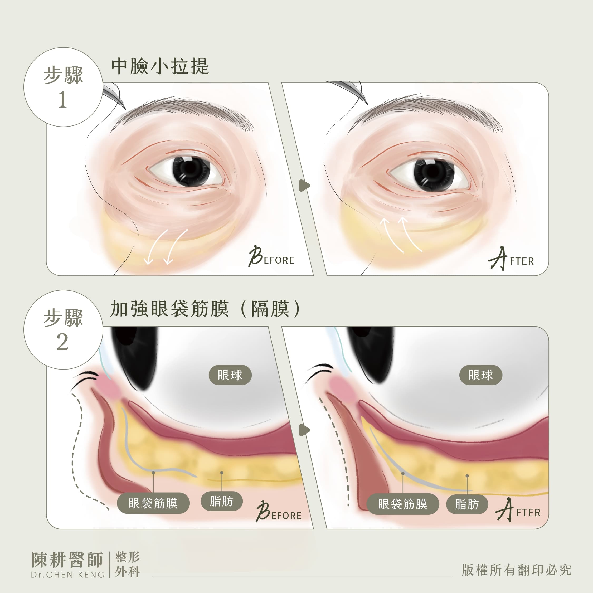 眼袋外開照片-2