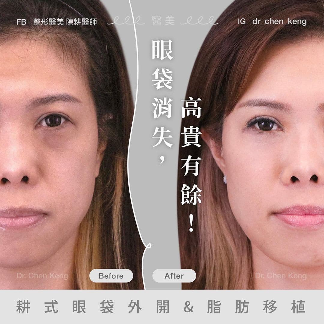 眼袋手術臥蠶會不見嗎?