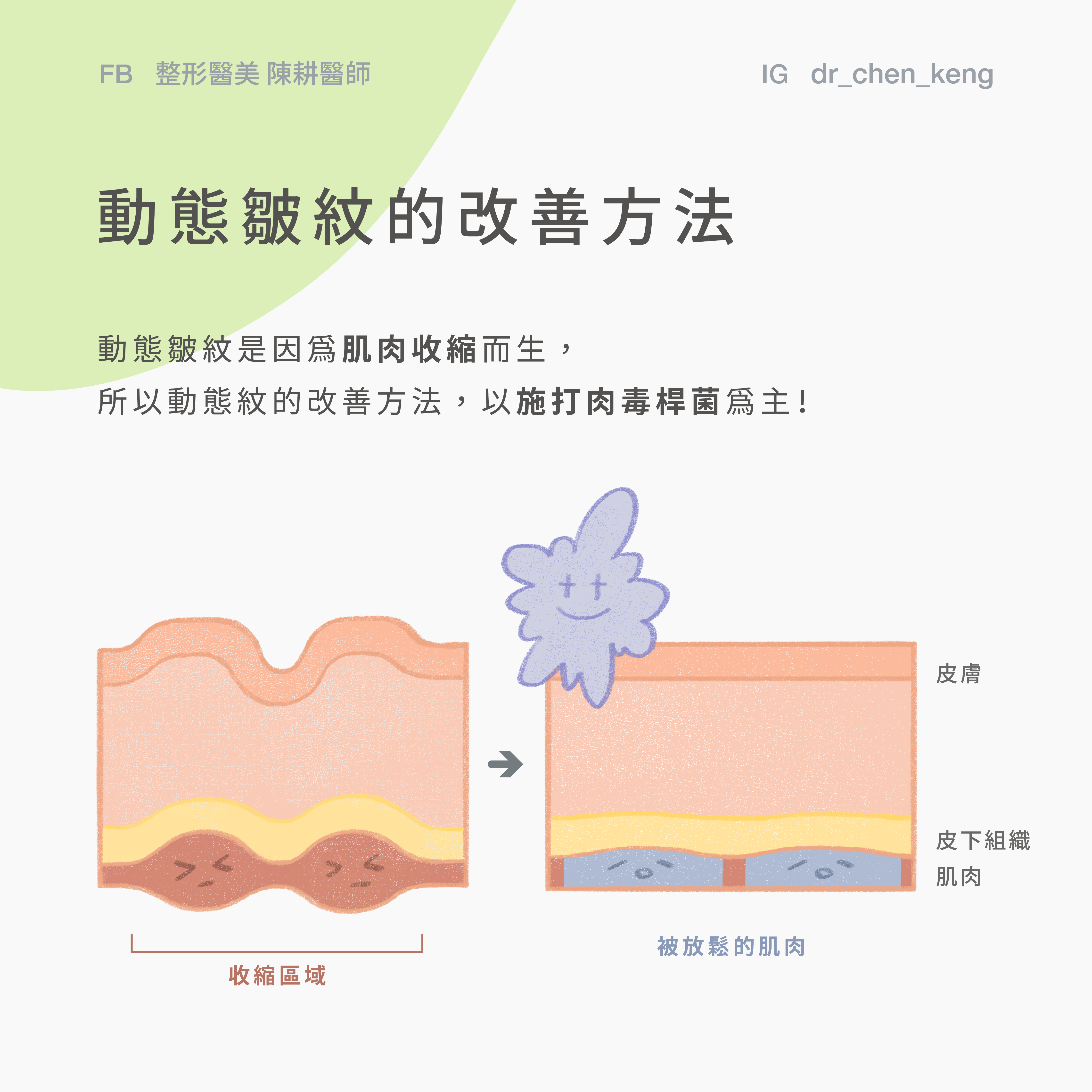 肉毒桿菌處理動態皺紋 抬頭紋、魚尾紋、皺眉紋、下巴紋